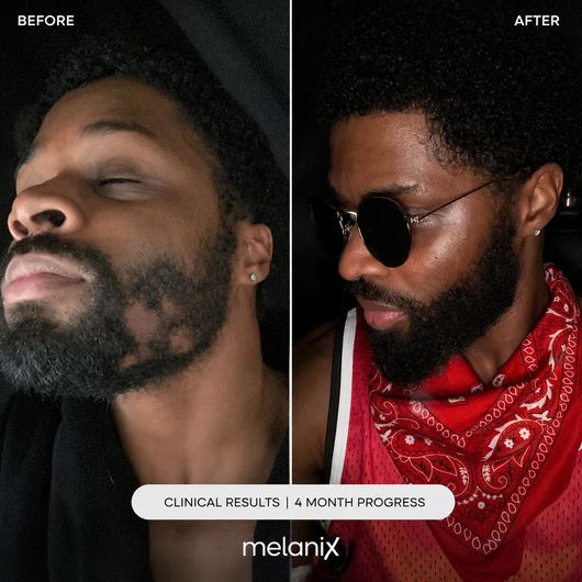 Melanix Beard Growth Serum